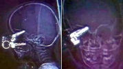 Американские врачи вылечили полуторагодовалого ребенка с попавшим в мозг ключом http://autokey.zp.ua/( Victor )