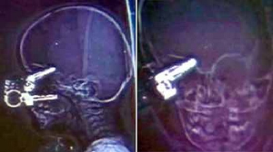 Американские врачи вылечили полуторагодовалого ребенка с попавшим в мозг ключом http://autokey.zp.ua/( Victor )